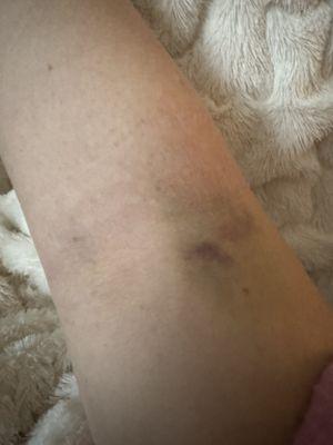 5 day old bruising from multiple attempts