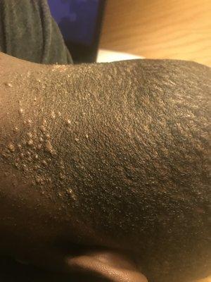 Razor bumps from first hair cut at this barber shop