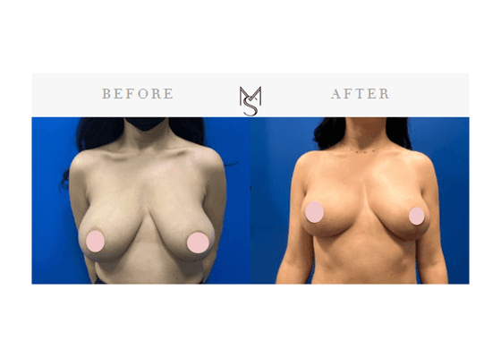 Breast Lift Surgery