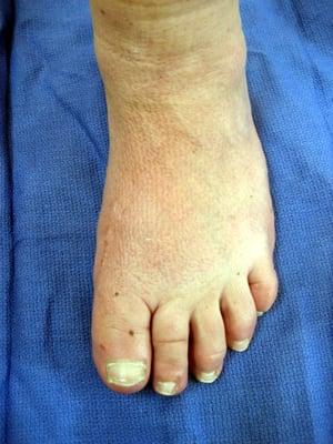 Bunion (After Surgery)