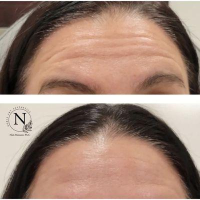 Botox Treatment Before and After