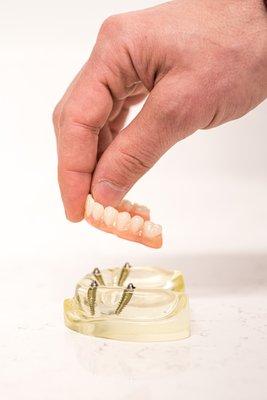 All-on-4 dental implants model