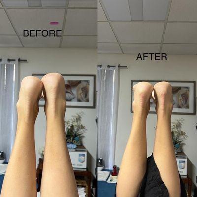 Before and after hip correction.