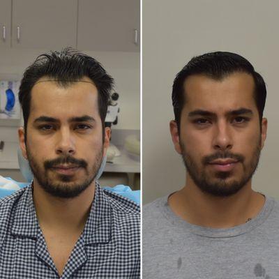 6 months post FUE Hair Transplant @50% growth. Double density still to come following next 10 months. Client had zones 1 and 2 restored.