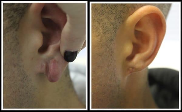 Procedure: Ear Lobe Repair

Actual patient of Dr. Hannah Vargas