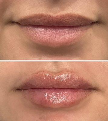 Lip augmentation by Nurse Alyssa