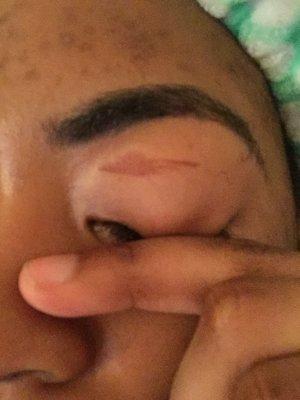 Eyelid burned from hot wax