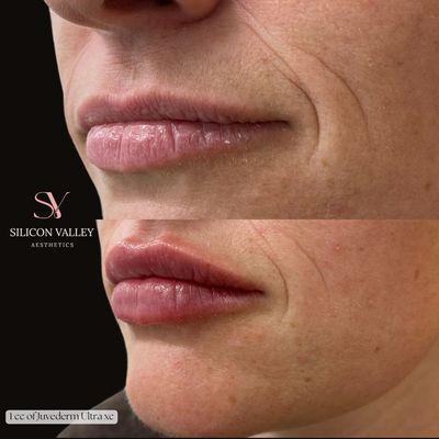 Lip Augmentation