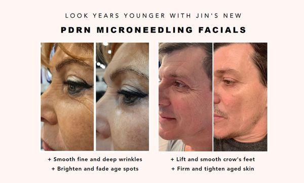 Real before and after photos after 3 to 5 sessions of PDRN microneedling facials