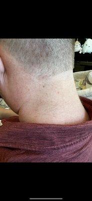 Patchy hair left on neck