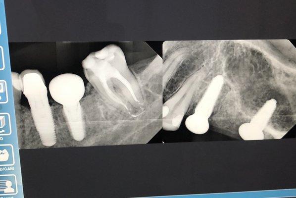 A poorly done root canal