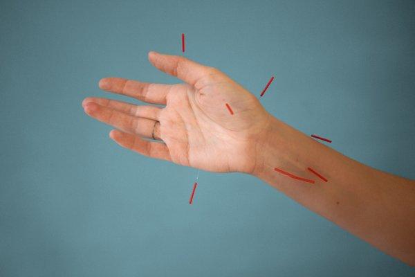 Hand with acupuncture needles