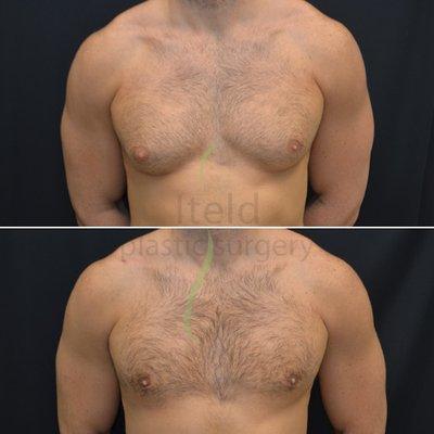 Gynecomastia (male breast reduction) - before and after