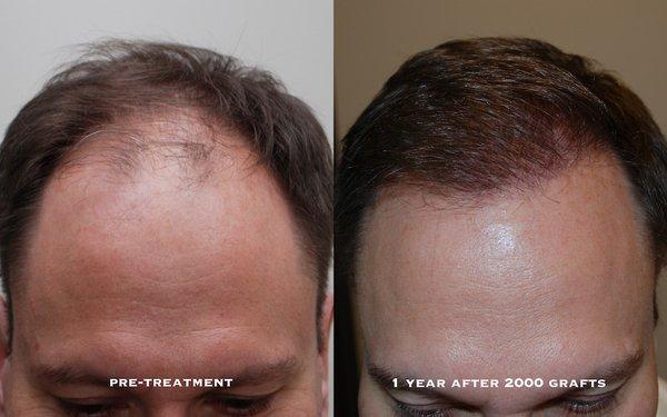 Before and After Hair Restoration Procedure