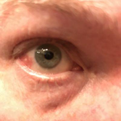 In Dec 6, 2016 for annual eye exam.  Mentioned that it felt like something was in my right eye. Dr Peabody said it may be a wart. Next?