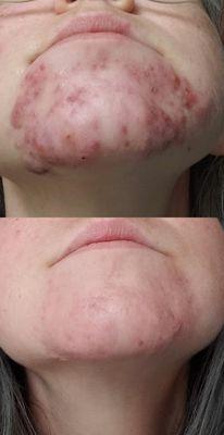 Before and after Accutane treatment