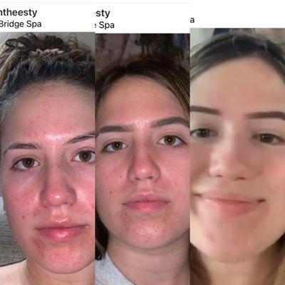 Before and after facials and home care