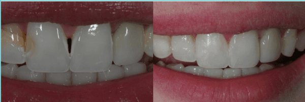 Before & After Results at The Office of Keith G. Lorio, DDS| Baton Rouge, LA