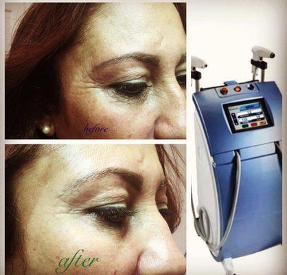 ANTI-AGING TREATMENT WITH OUR LASER (ALMA) FOR MORE INFO CALL US AT 917-207-0448