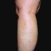 spider veins after treatment