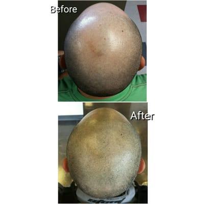 Scalp Micropigmentation hair restoration in Salt Lake City, Utah.