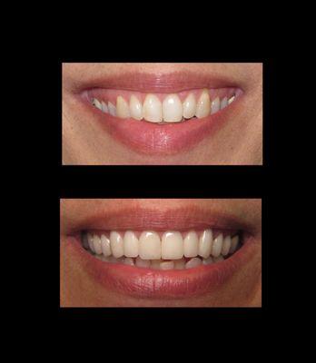 Before/After full set of veneers with gum re-contouring.