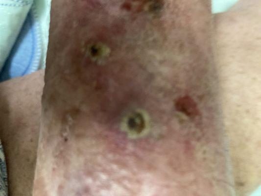 Results of Scabies