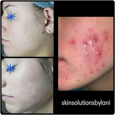 Acne/Scar Treatment