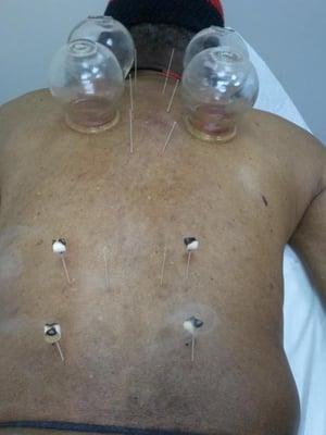 Patient receiving Acupuncture with Moxabustion and Cupping therapy for relief of back pain.