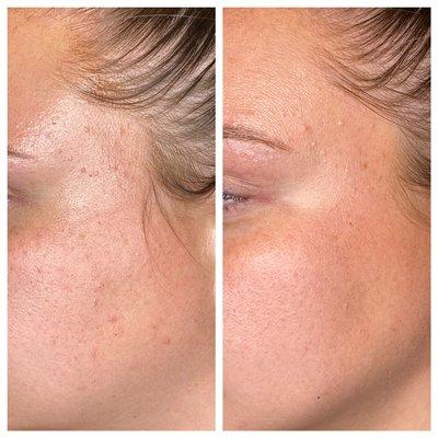 One week post microdermabrasion on right side.