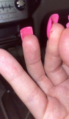 Painful swollen fingers, nails were glued to skin which cause skin to tear open