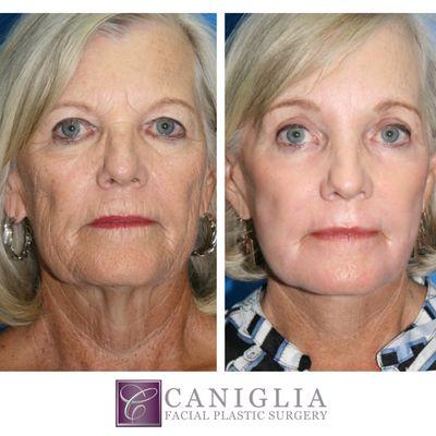 71 year old patient underwent facelift/necklift, upper & lower eyelid surgery, endoscopic forehead lift and full face laser resurfacing.