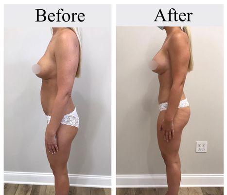 Before and After:
Procedure: Mommy Makeover
This patient did a Tummy Tuck with Removal and Replacement of Silicone Breast Implants