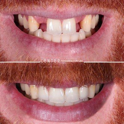 Patient was missing 2 lateral incisors since birth. Permanent dental implants were placed & matched to look & function like his real teeth!