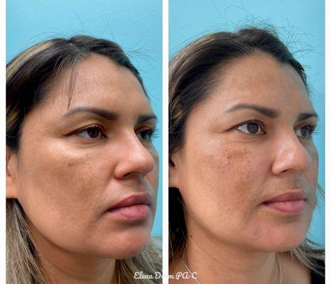 Elena PA-C , used Voluma to treat Cheeks and Periform Fossa. Then used RHA3 to fill Nasolabial Folds, Marionette Lines, Oral Commissures.