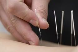 Acupuncture has effectively treated pain and a myriad of diseases for thousands of years