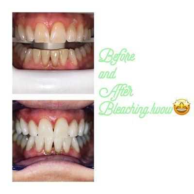 Another satisfied and happy patient with our Whitening treatment  come and get yours today!