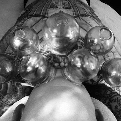 Cupping for back pain