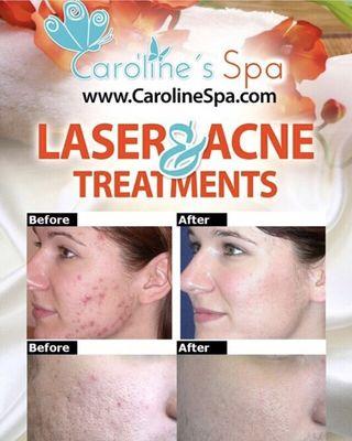 Acne treatment with Laser