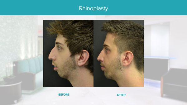 Real Results Before & After-Rhinoplasty