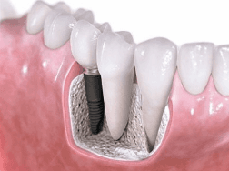 Dental implants, Battle Ground, WA