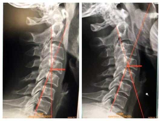 My neck is starting to get its natural curve back! Went from a 20° angle to 36° after 3 months of care (Dr. Nick says the goal is 45°)