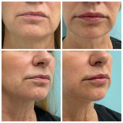 Michele RN used versa filler on lips.

#versa #versafiller #lipfiller