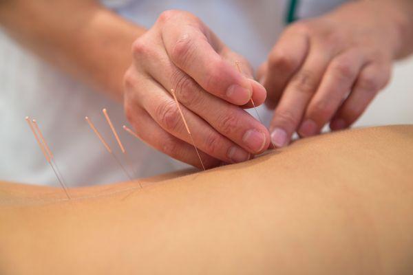 Acupuncture for musculoskeletal pain or internal conditions.