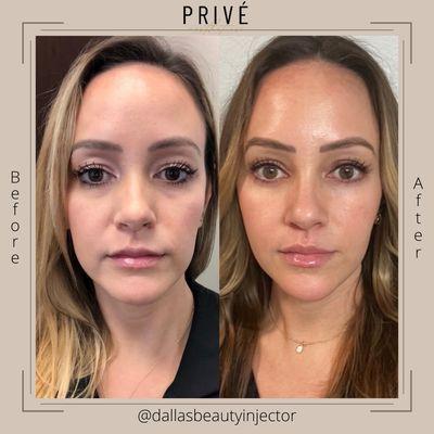 Consistency, trust in procedures, skincare, neurotoxin, a little filler & a lot of love 

2018 -- 2022 with @dallasbeautyinjector