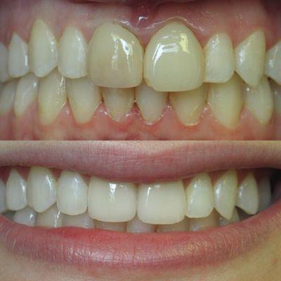 BEFORE (top) & AFTER (bottom)  Teeth Whitening & Crowns