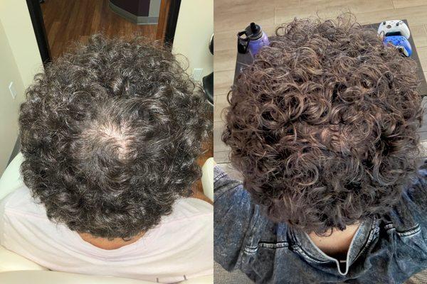 Results after 3/6 treatments of our unique, science-driven hair restoration and preservation program - Hairworks.