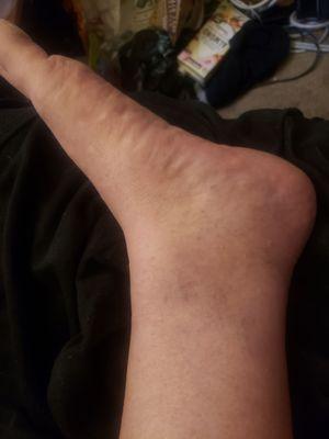 Bruised and damaged ankle. Much worse when I visited.