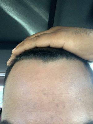 Hair line