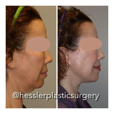 A deep plane facelift and neck lift can define the neck and jawline. Surgery performed by Dr. Jill Hessler in our discrete surgery center.